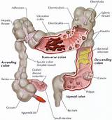Pictures of Colon Therapy