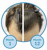 Pictures of Widows Peak Hair Loss Treatment
