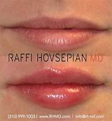 Best Lip Augmentation Doctor Images