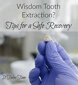 When Can I Chew After Wisdom Teeth E Traction