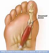 Tibial Sesamoid Fracture Treatment Images