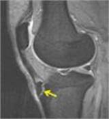 Images of Osgood Schlatter Surgery Recovery Time