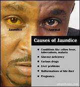 Jaundice Symptoms And Treatment Pictures