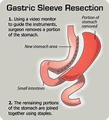 Photos of Gas After Gastric Sleeve