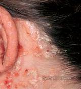 Severe Scalp Psoriasis Treatment Pictures