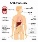 Crohn''s Disease Gas Problems Pictures