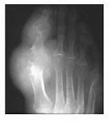 How Do Doctors Test For Gout Photos