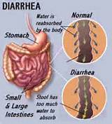 Acute Diarrhea Home Remedies