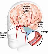 Mini Stroke Treatment Recovery Images