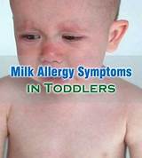 Pictures of Milk Allergy Treatment