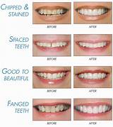 Teeth Bonding Insurance Photos