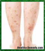 Images of Mild Psoriasis Home Remedies