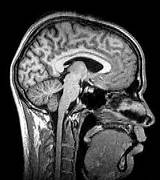 Mri Scan What Can It Detect Images
