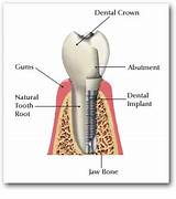 Permanent Dental Implants Procedure