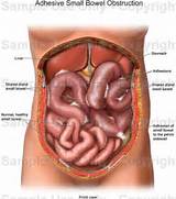 Home Remedies For Bowel Obstruction Pictures