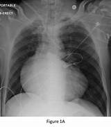 Images of Pulmonary Artery Dilatation Treatment