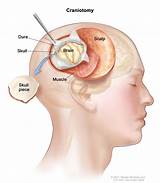 Images of Lesion On Pituitary Gland Treatment
