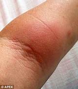 Cat Claw Infection Treatment Images