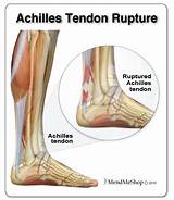 Pictures of Insertional Achilles Tendonitis Surgery Recovery Time