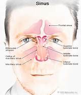 Home Remedies For Swollen Nasal Turbinates