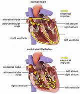 Medications For Svt Heart Images