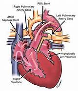 Glenn Procedure Recovery Pictures