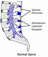 Hole In Spine Treatment Images