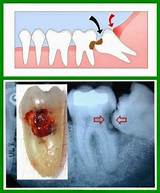 Wisdom Teeth No Dental Insurance Images