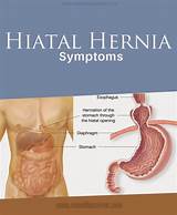 Hiatal Hernia Pain Relief Treatment Images