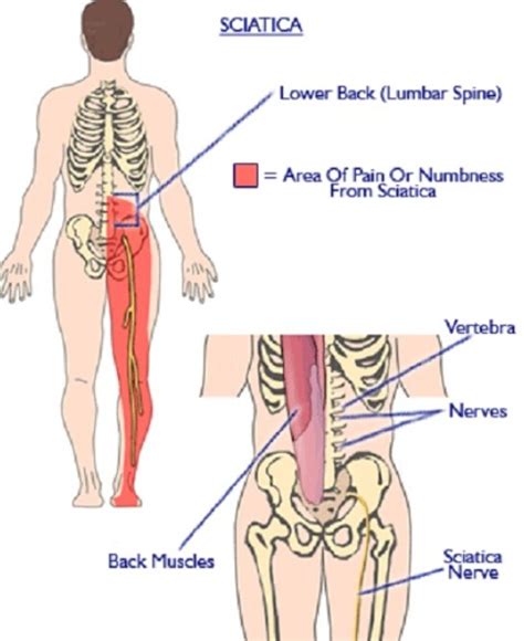 Pictures of Low Back Pain Right Side Above Buttocks