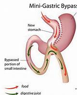 Can A Gastric Bypass Be Revised Images