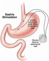 Gastric Electrical Stimulation For Gastroparesis Images