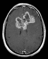 Images of Glioblastoma Multiforme Treatment Options