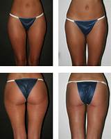 Images of Good Liposuction Doctors
