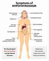 Hypothyroidism And Gas Pictures