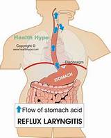 What Kind Of Doctor To See For Acid Reflux Pictures