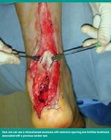 Insertional Achilles Tendonitis Surgery Recovery Time Pictures