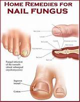 Images of Infection Under Fingernail Home Remedies