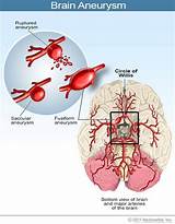 Pictures of Recovery After Brain Aneurysm