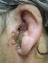 Fluid On Eardrum Home Remedies Images