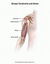 Lower Bicep Tendonitis Treatment Pictures