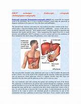 Images of What Is A Ercp Medical Procedure