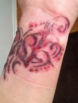 Henna Tattoo Allergy Treatment Images
