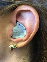 Tubes In Ears Surgery For Infants Pictures