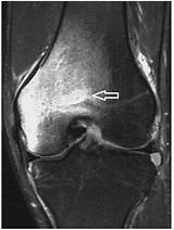 Knee Effusion Recovery Time Images