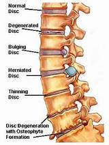 Chiropractic Treatment For Bulging Disc In Lower Back Pictures
