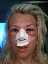 Recovery After Deviated Septum Surgery Photos