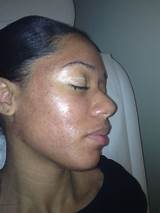 Mask After Chemical Peel Photos