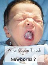 Thrush In Newborns Home Remedies