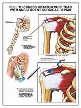 Pictures of Rotator Cuff Therapy Protocol